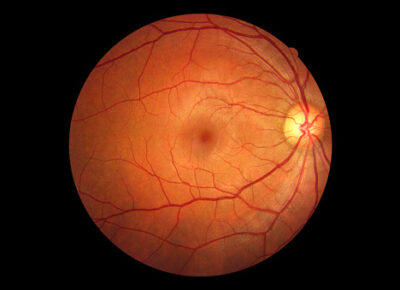 Retina/Diabetes/Macula Eye Treatment